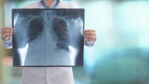 Doctor holding X-ray film of lungs